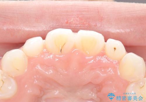 【ダイレクトボンディング】歯を削らずに綺麗にしたい。 の治療前