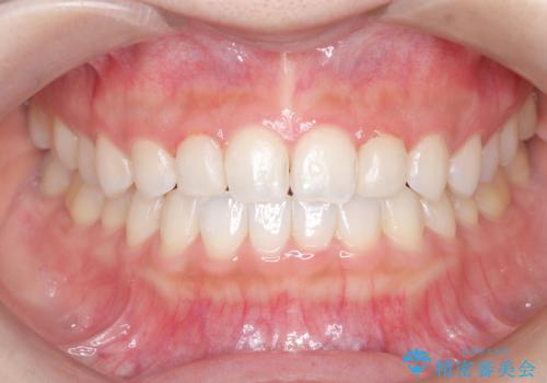 【ダイレクトボンディング】歯を削らずに綺麗にしたい。 の治療後