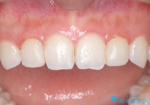 【ダイレクトボンディング】歯を削らずに綺麗にしたい。 の症例 治療後