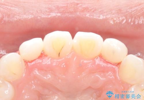 【ダイレクトボンディング】歯を削らずに綺麗にしたい。 の治療後