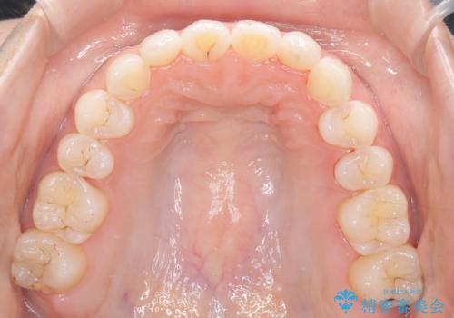 【インビザライン】矮小歯を有する方の矯正治療の治療後