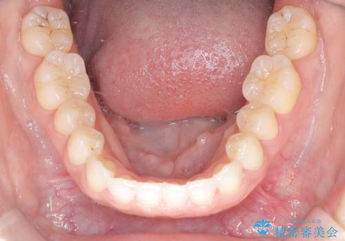 【インビザライン】矮小歯を有する方の矯正治療の治療後