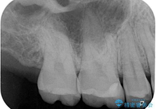 銀歯を白くしたい セラミックインレー修復の治療後