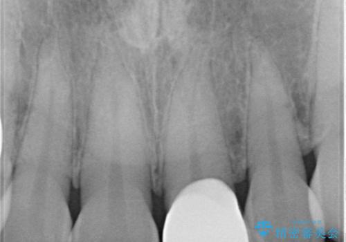 前歯をきれいにしたい　オールセラミッククラウンの治療後