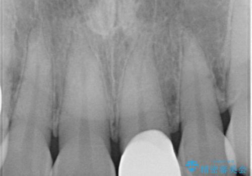 前歯をきれいにしたい オールセラミッククラウンの治療後