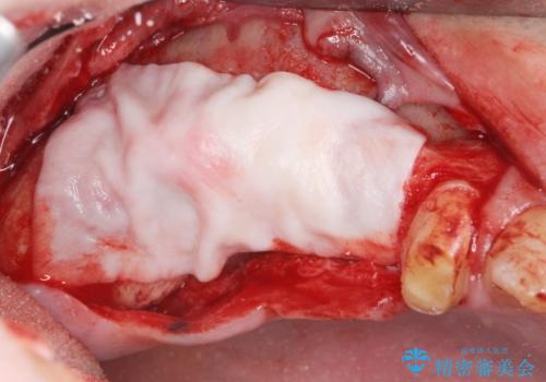 骨の造成を伴う奥歯のインプラント治療の治療中
