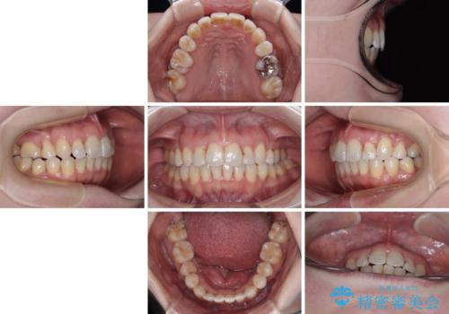 飛び出した上顎前歯と上下のデコボコ　片顎の抜歯によるワイヤー矯正の治療後
