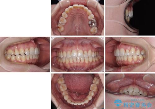 飛び出した上顎前歯と上下のデコボコ 片顎の抜歯によるワイヤー矯正の治療後
