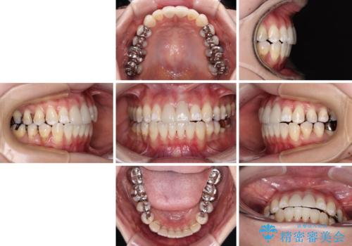 気になる前歯 ワイヤー矯正とセラミック治療の治療後