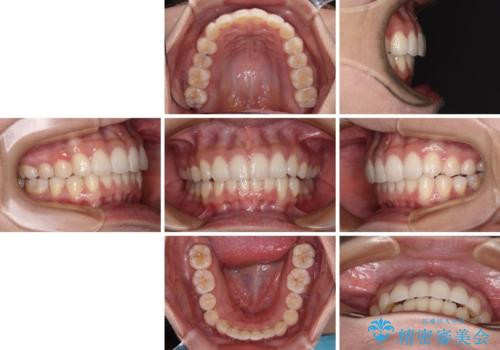 前歯のデコボコを解消　インビザラインの矯正治療の治療後