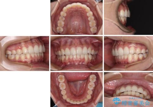 前歯のデコボコを解消 インビザラインの矯正治療の治療後