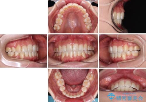 デコボコと出っ歯　抜歯矯正でスッキリとした口元にの治療後