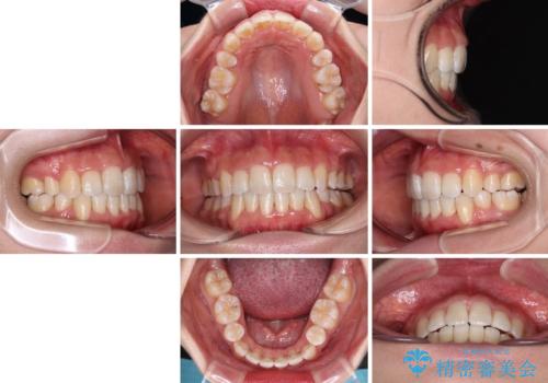 デコボコと出っ歯 抜歯矯正でスッキリとした口元にの治療後