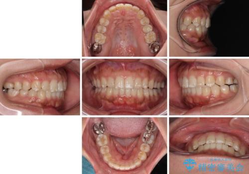 インビザライン・モデレートを用いて気になる前歯を短期間で矯正治療の治療後