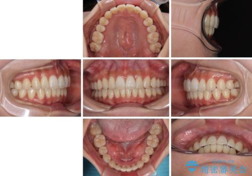 【モニター】上顎前突と奥歯の鋏状咬合 補助装置を用いたインビザライン矯正治療の治療後