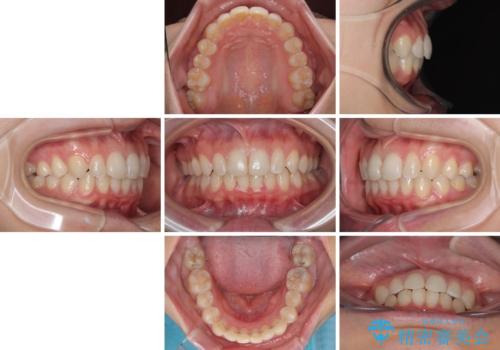 埋もれた奥歯をワイヤーで改善　インビザラインによる矯正治療の治療後