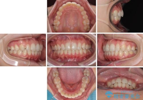 埋もれた奥歯をワイヤーで改善 インビザラインによる矯正治療の治療後