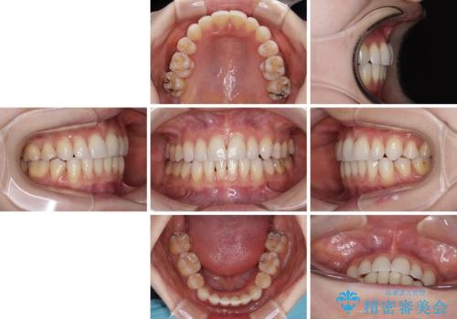 【モニター】顎のゆがみをカムフラージュ ワイヤー装置の抜歯矯正の治療後