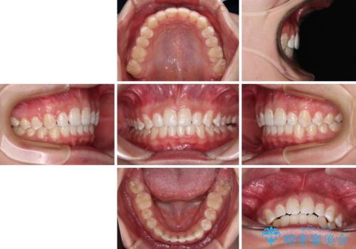食いしばり癖を改善したい　ディープバイトのワイヤー矯正の治療後