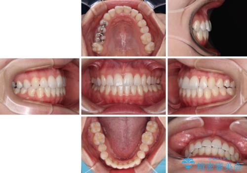 骨格的な問題を側方拡大で解決　ワイヤー矯正治療の治療後