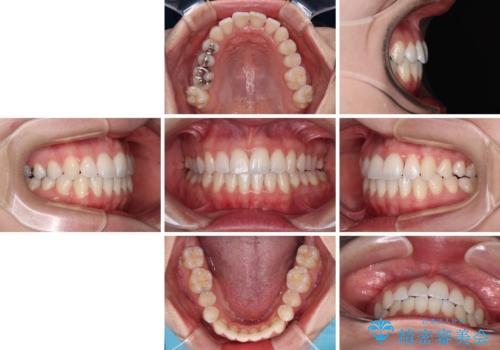 骨格的な問題を側方拡大で解決 ワイヤー矯正治療の治療後