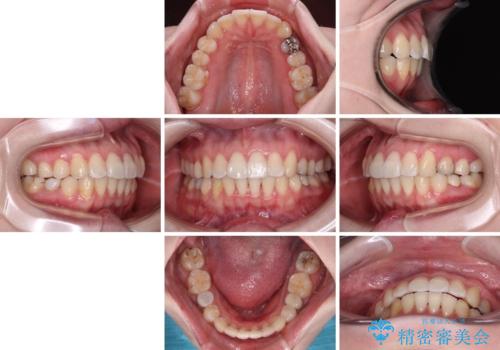 開咬と前方に飛び出した前歯 インビザラインによる矯正治療の治療後