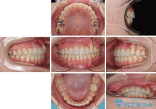 急速拡大装置　狭い上顎骨を拡大してワイヤー装置で八重歯を短期間治療の治療後