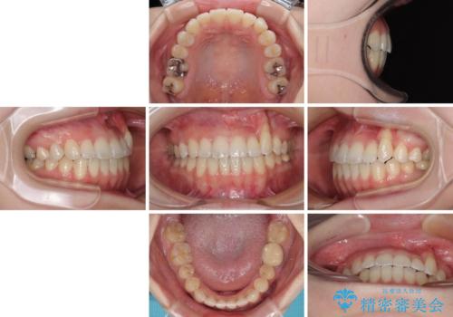 急速拡大装置 狭い上顎骨を拡大してワイヤー装置で八重歯を短期間治療の治療後