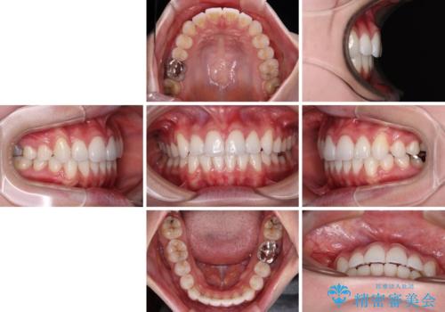 八重歯を確実に改善 補助装置を併用したインビザライン矯正治療の治療後