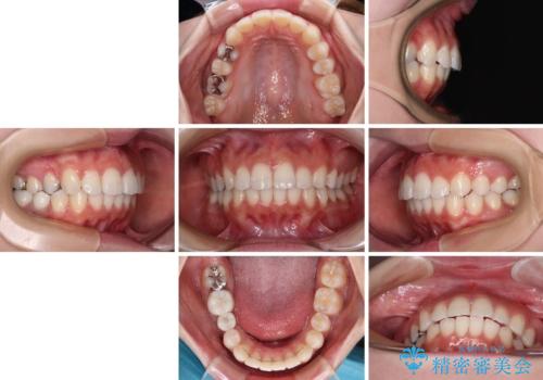 欠損した歯と前に飛び出した前歯　インプラント治療を併用したワイヤー矯正治療の治療後