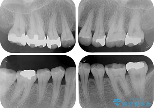 奥歯の銀歯をゴールドでしっかりと治療の治療後