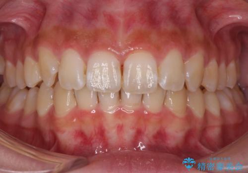 前歯の並び　インビザライン　非抜歯で　深いかみ合わせの治療の症例 治療後