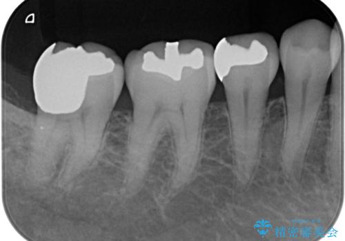 虫歯を治したい。ゴールドアンレーでの治療の治療後