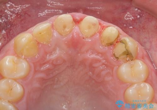 歯周外科を行い、歯ぐきの状態を整えた前歯セラミック治療の治療前