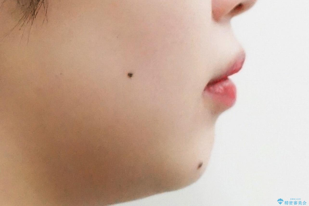 前歯の並び インビザライン 非抜歯で 深いかみ合わせの治療の治療前(顔貌)