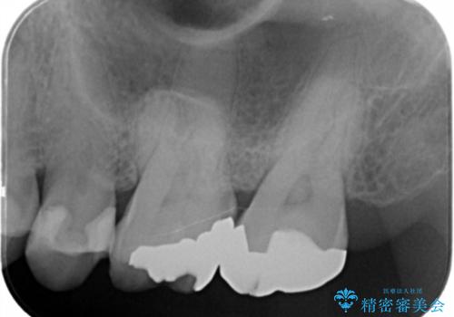 [ メタルフリー ] 金属を外してセラミック治療の治療前