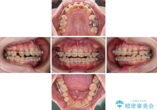 飛び出した上顎前歯と上下のデコボコ　片顎の抜歯によるワイヤー矯正の治療中