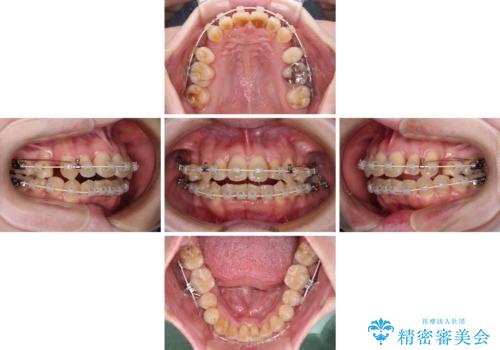 飛び出した上顎前歯と上下のデコボコ 片顎の抜歯によるワイヤー矯正の治療中
