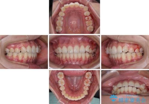 前歯のデコボコを解消 インビザラインの矯正治療の治療中