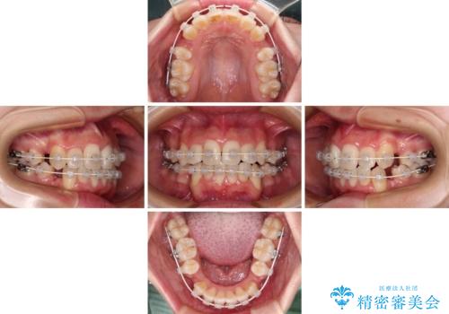 デコボコと出っ歯　抜歯矯正でスッキリとした口元にの治療中