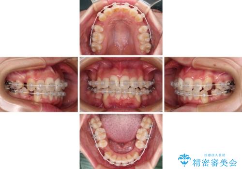 デコボコと出っ歯 抜歯矯正でスッキリとした口元にの治療中