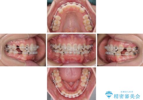 閉じにくい口元をワイヤー抜歯矯正でスッキリ改善の治療中