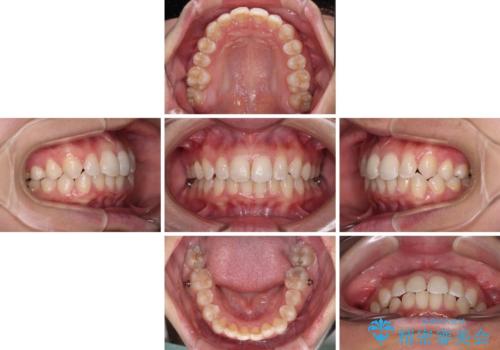 埋もれた奥歯をワイヤーで改善 インビザラインによる矯正治療の治療中