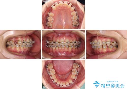 【モニター】顎のゆがみをカムフラージュ　ワイヤー装置の抜歯矯正の治療中