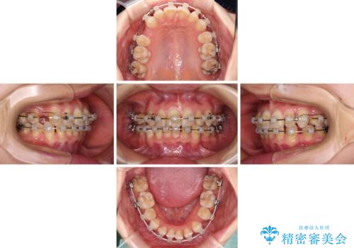 【モニター】顎のゆがみをカムフラージュ ワイヤー装置の抜歯矯正の治療中