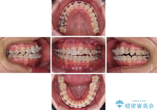骨格的な問題を側方拡大で解決　ワイヤー矯正治療の治療中