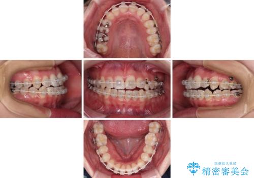骨格的な問題を側方拡大で解決 ワイヤー矯正治療の治療中