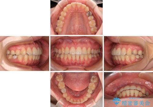 開咬と前方に飛び出した前歯 インビザラインによる矯正治療の治療中