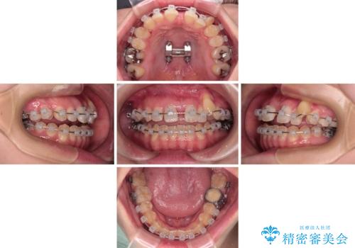 急速拡大装置　狭い上顎骨を拡大してワイヤー装置で八重歯を短期間治療の治療中