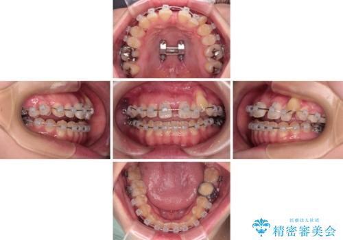 急速拡大装置 狭い上顎骨を拡大してワイヤー装置で八重歯を短期間治療の治療中